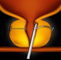 UroLift Treatment