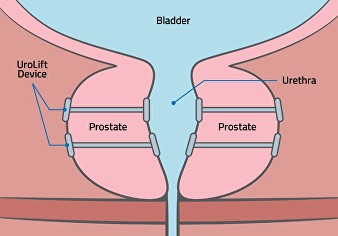 benefits of urolift