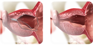 iTind device (3 to 4)