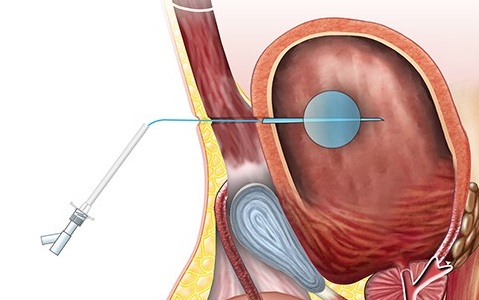 Suprapubic Catheter