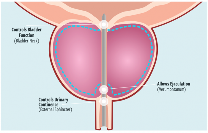 Aquablation therapy surgical map